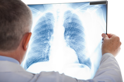 What Are Causes of Lung Cancer? Signs, Symptoms, Treatment, Prevention, national cpr foundation